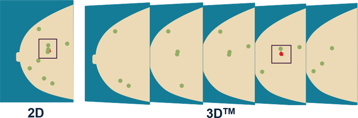 3Dマンモグラフィ