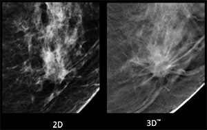 3Dマンモグラフィが有効な方